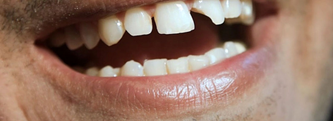 علت شکستگی دندان
