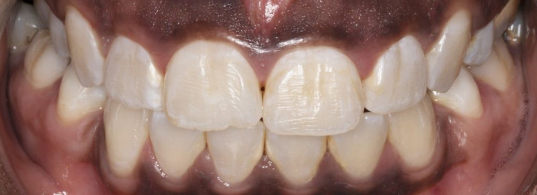 علت سیاه شدن لثه بعد از ایمپلنت دندان چیست