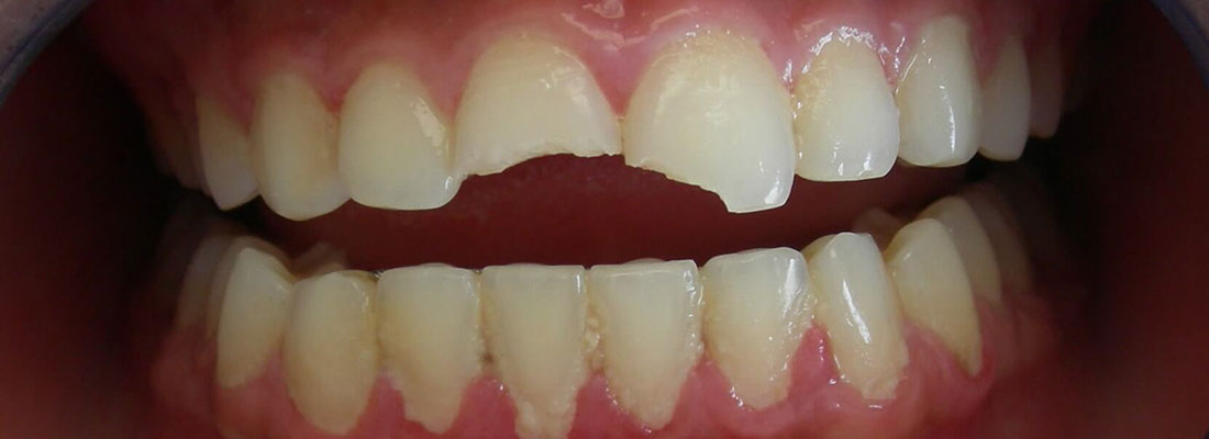 علت شکستگی دندان شامل چه مواردی می شود