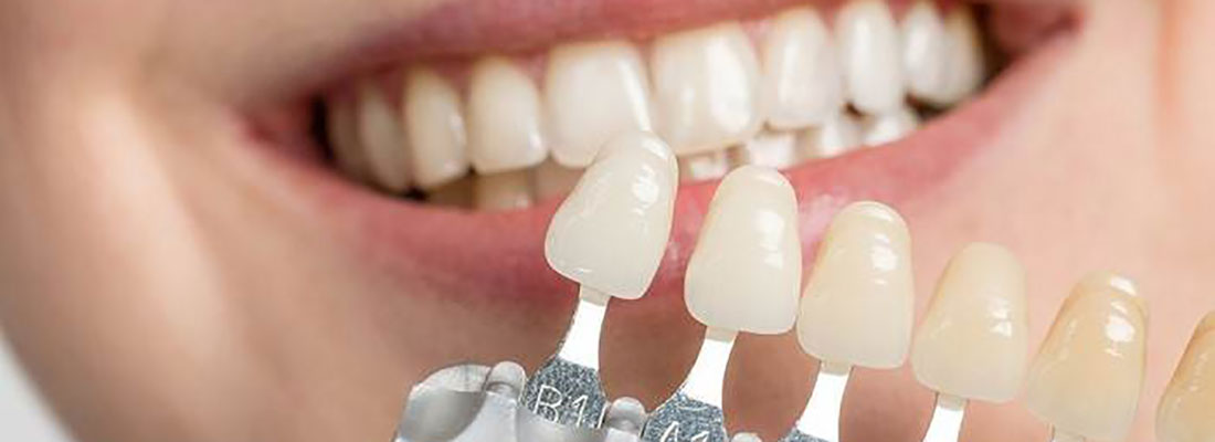 لمینیت دندان مناسب چه کسانی است